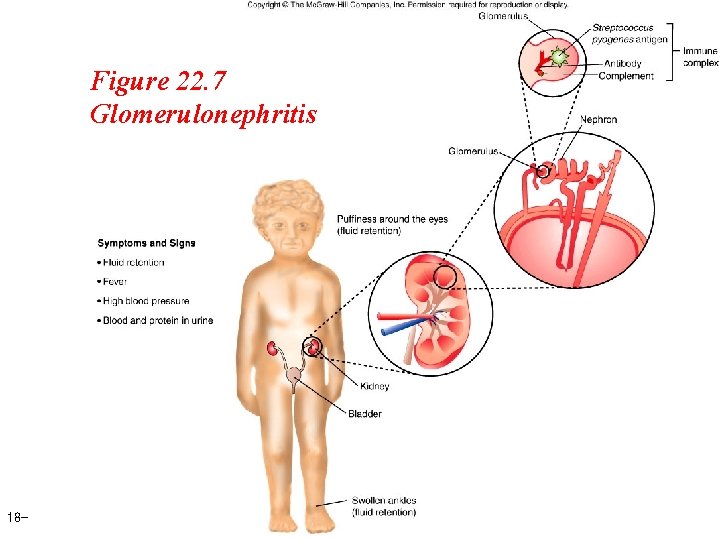 Figure 22. 7 Glomerulonephritis 18 - 