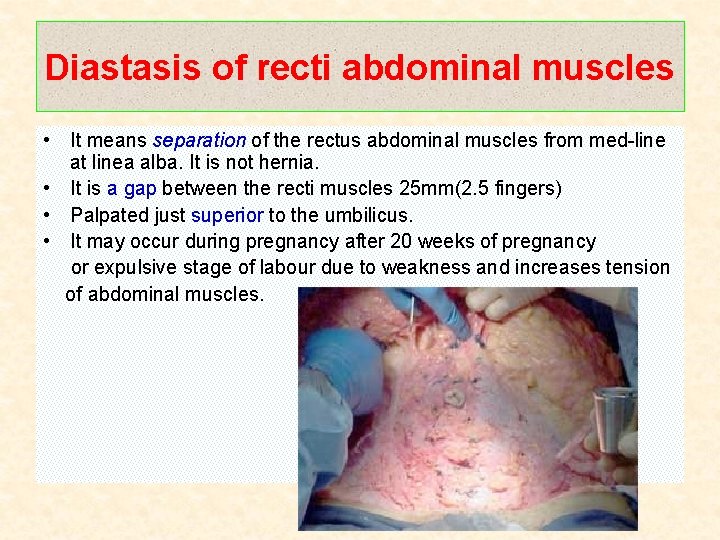 Diastasis of recti abdominal muscles • It means separation of the rectus abdominal muscles