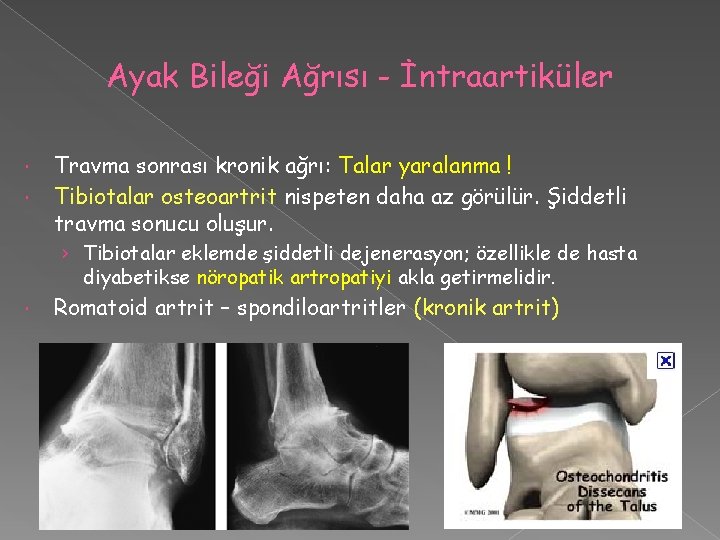 Ayak Bileği Ağrısı - İntraartiküler Travma sonrası kronik ağrı: Talar yaralanma ! Tibiotalar osteoartrit