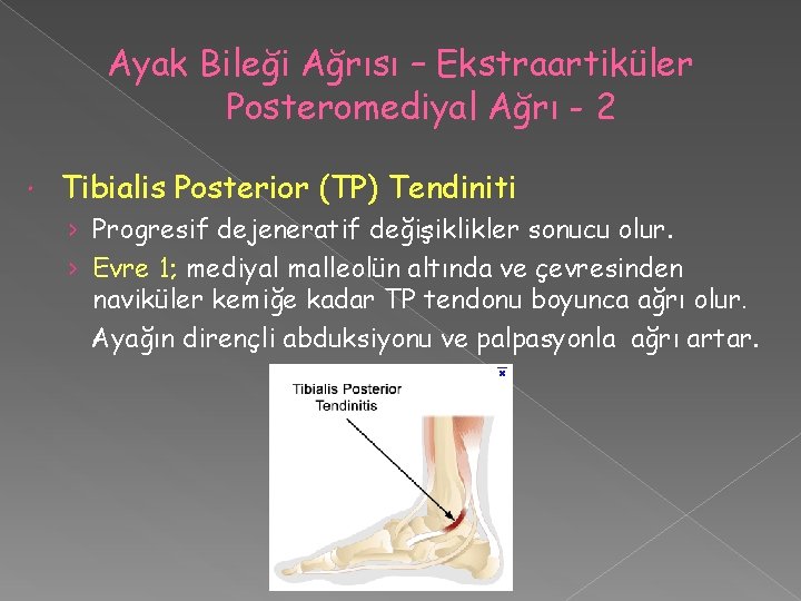 Ayak Bileği Ağrısı – Ekstraartiküler Posteromediyal Ağrı - 2 Tibialis Posterior (TP) Tendiniti ›