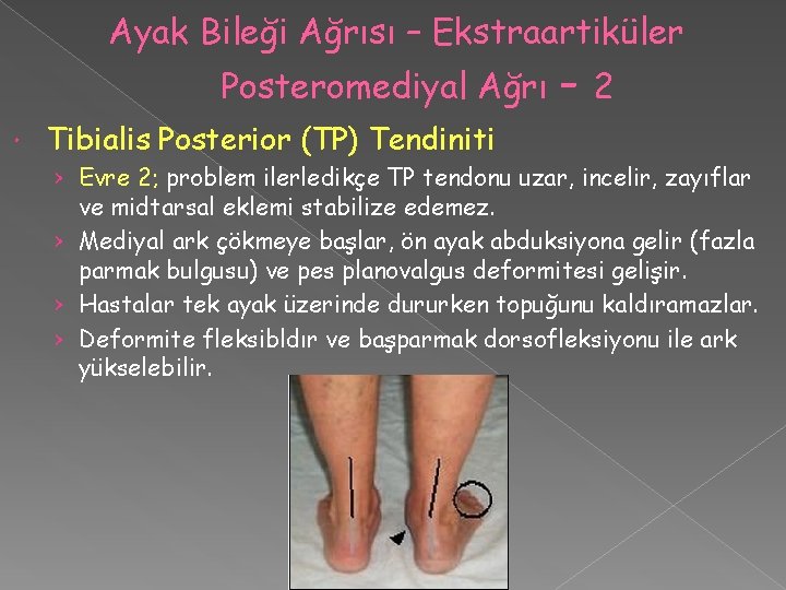 Ayak Bileği Ağrısı – Ekstraartiküler Posteromediyal Ağrı -2 Tibialis Posterior (TP) Tendiniti › Evre