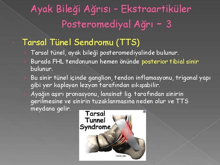 Ayak Bileği Ağrısı – Ekstraartiküler Posteromediyal Ağrı -3 Tarsal Tünel Sendromu (TTS) › Tarsal