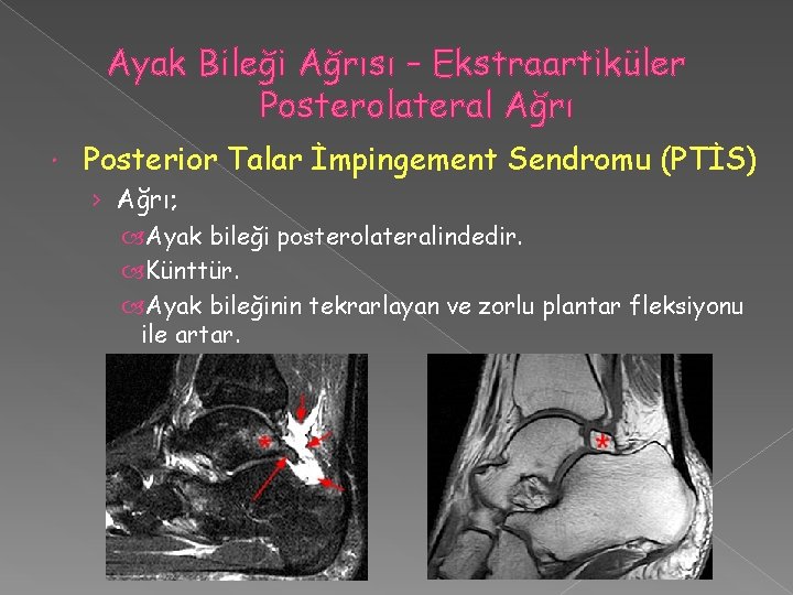 Ayak Bileği Ağrısı – Ekstraartiküler Posterolateral Ağrı Posterior Talar İmpingement Sendromu (PTİS) › Ağrı;