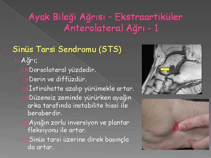 Ayak Bileği Ağrısı – Ekstraartiküler Anterolateral Ağrı - 1 Sinüs Tarsi Sendromu (STS) ›
