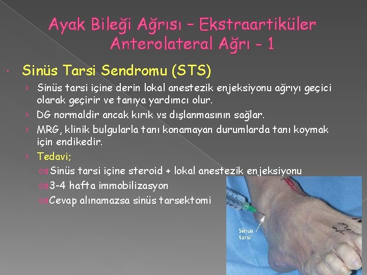 Ayak Bileği Ağrısı – Ekstraartiküler Anterolateral Ağrı - 1 Sinüs Tarsi Sendromu (STS) ›