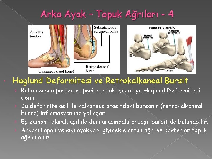 Arka Ayak – Topuk Ağrıları - 4 Haglund Deformitesi ve Retrokalkaneal Bursit › Kalkaneusun