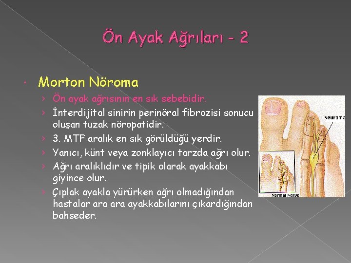 Ön Ayak Ağrıları - 2 Morton Nöroma › Ön ayak ağrısının en sık sebebidir.