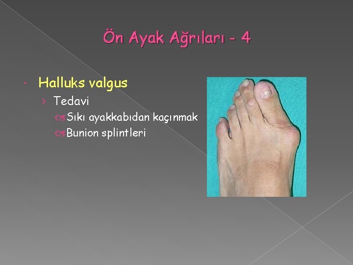 Ön Ayak Ağrıları - 4 Halluks valgus › Tedavi Sıkı ayakkabıdan kaçınmak Bunion splintleri