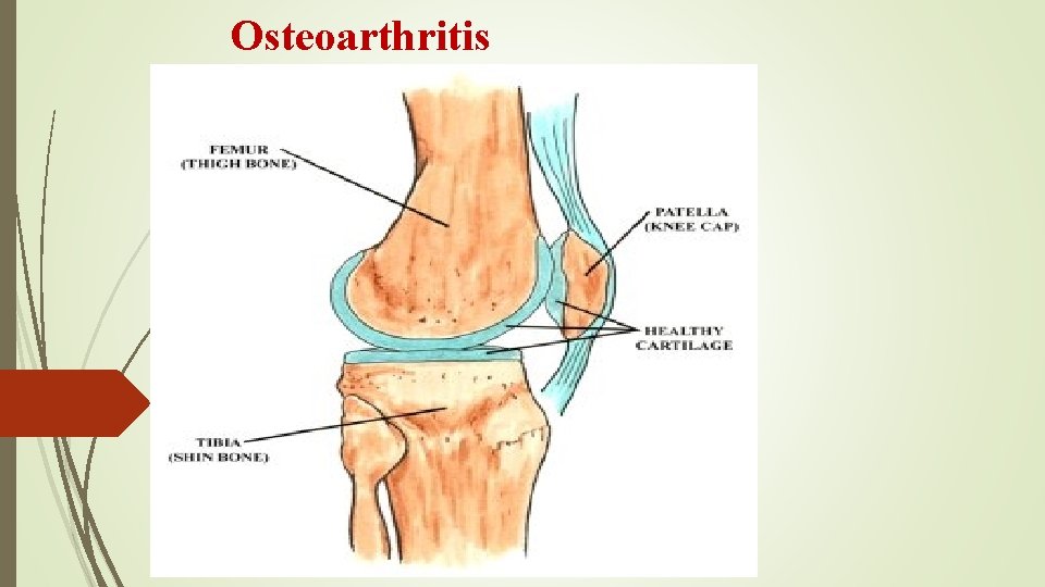 Osteoarthritis 