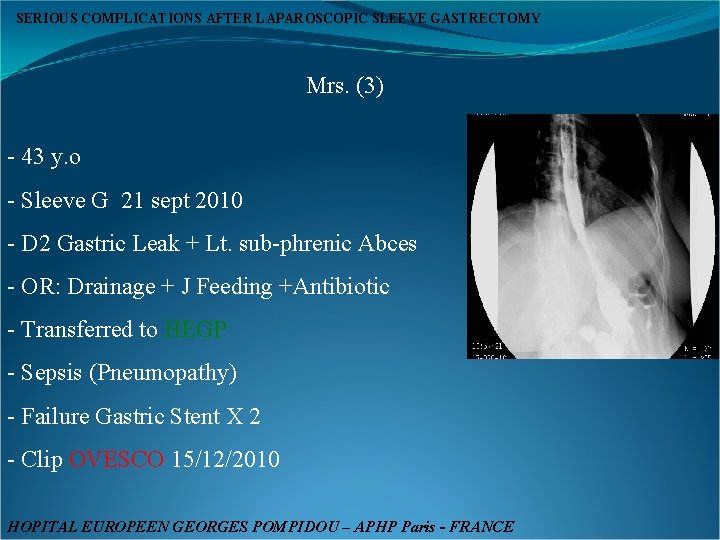 SERIOUS COMPLICATIONS AFTER LAPAROSCOPIC SLEEVE GASTRECTOMY Mrs. (3) - 43 y. o - Sleeve