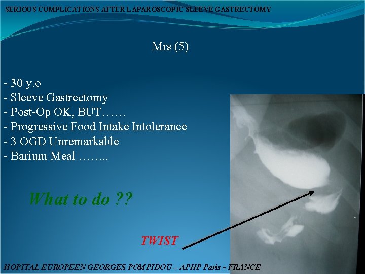 SERIOUS COMPLICATIONS AFTER LAPAROSCOPIC SLEEVE GASTRECTOMY Mrs (5) - 30 y. o - Sleeve