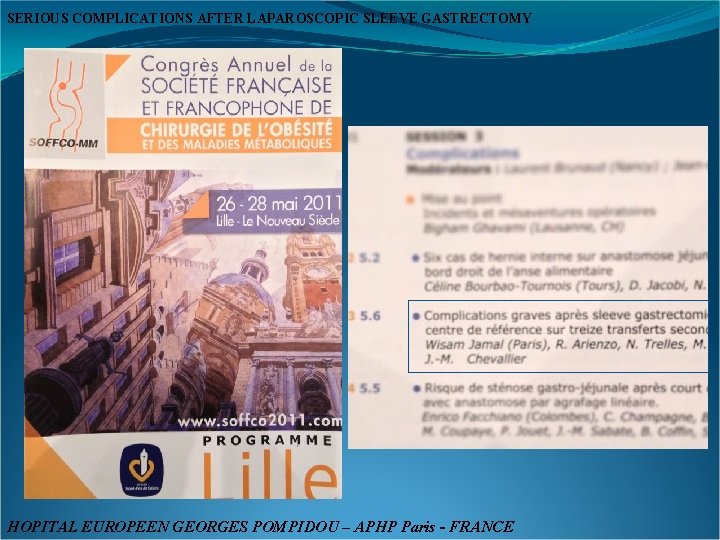 SERIOUS COMPLICATIONS AFTER LAPAROSCOPIC SLEEVE GASTRECTOMY HOPITAL EUROPEEN GEORGES POMPIDOU – APHP Paris -