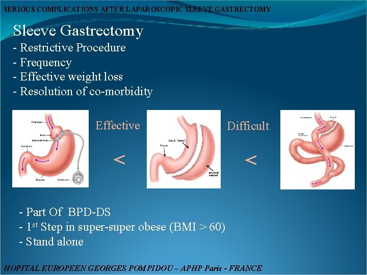 SERIOUS COMPLICATIONS AFTER LAPAROSCOPIC SLEEVE GASTRECTOMY Sleeve Gastrectomy - Restrictive Procedure - Frequency -