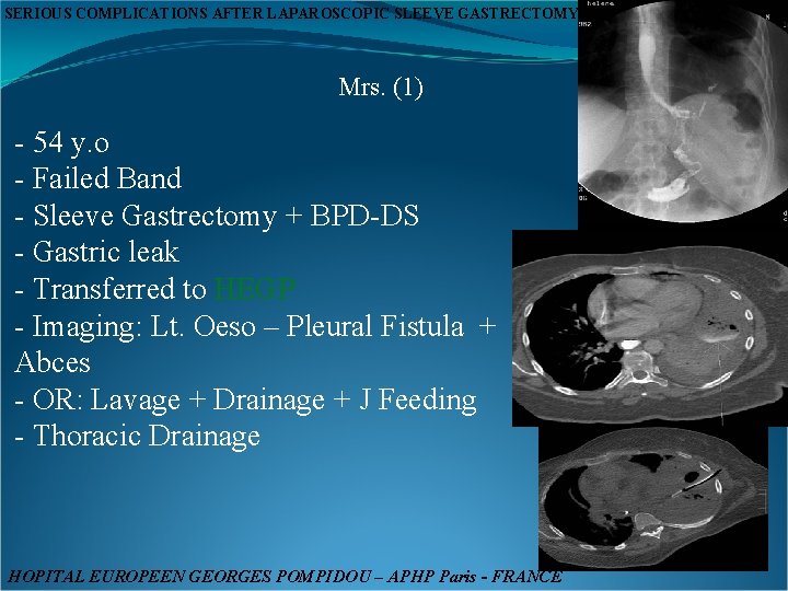 SERIOUS COMPLICATIONS AFTER LAPAROSCOPIC SLEEVE GASTRECTOMY Mrs. (1) - 54 y. o - Failed