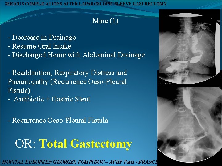 SERIOUS COMPLICATIONS AFTER LAPAROSCOPIC SLEEVE GASTRECTOMY Mme (1) - Decrease in Drainage - Resume