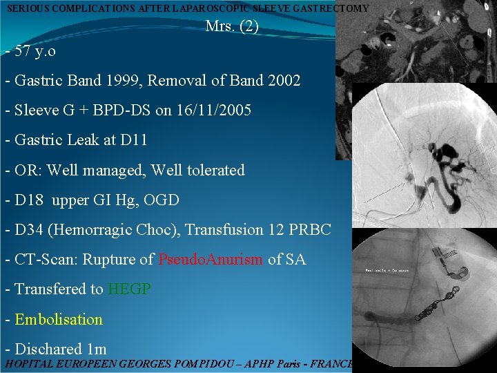 SERIOUS COMPLICATIONS AFTER LAPAROSCOPIC SLEEVE GASTRECTOMY Mrs. (2) - 57 y. o - Gastric