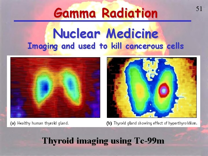 Gamma Radiation Nuclear Medicine Imaging and used to kill cancerous cells Thyroid imaging using