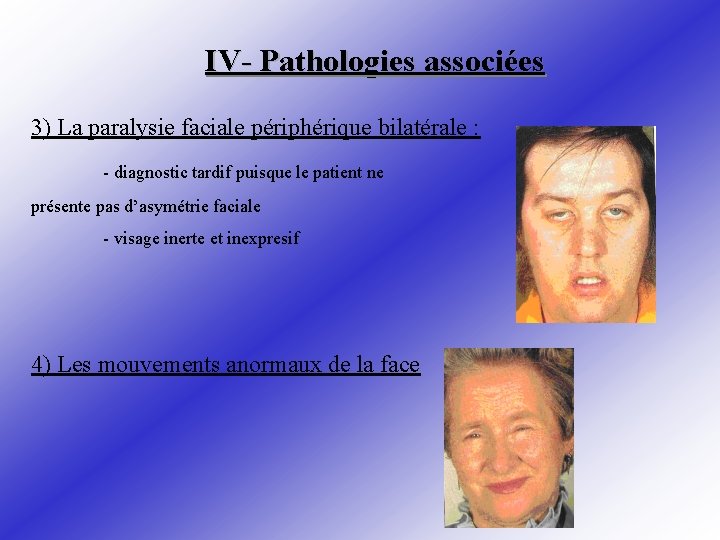 IV- Pathologies associées 3) La paralysie faciale périphérique bilatérale : - diagnostic tardif puisque