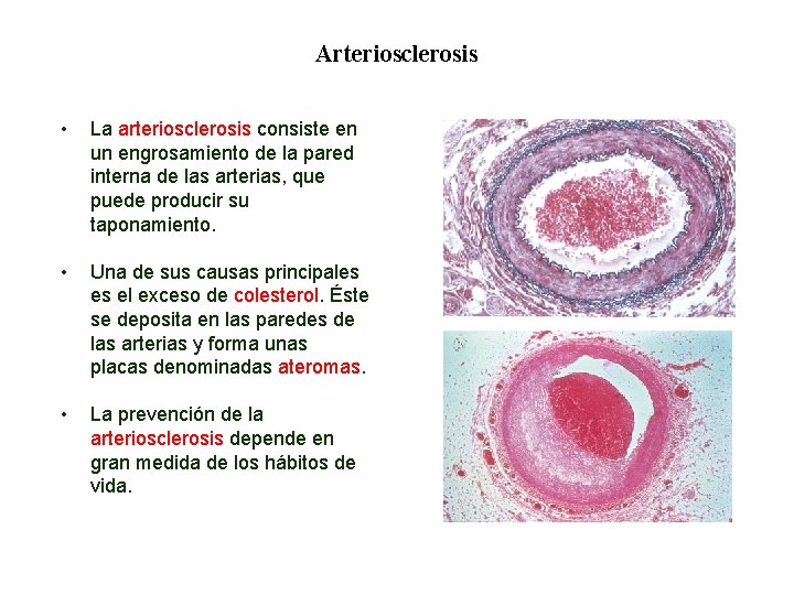 02 Arteriosclerosis • La arteriosclerosis consiste en un engrosamiento de la pared interna de