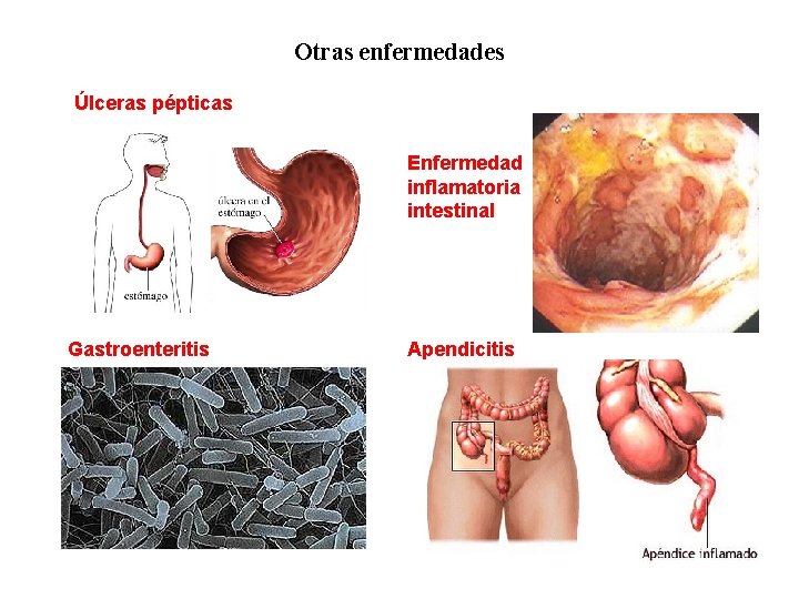 02 Otras enfermedades Úlceras pépticas Enfermedad inflamatoria intestinal Gastroenteritis Apendicitis 
