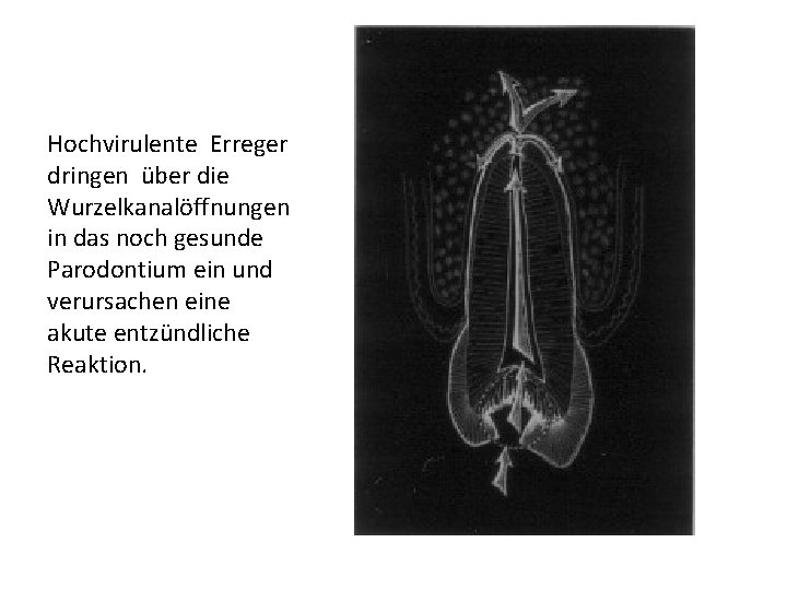 Hochvirulente Erreger dringen über die Wurzelkanalöffnungen in das noch gesunde Parodontium ein und verursachen