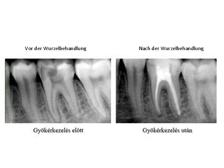 Vor der Wurzelbehandlung Nach der Wurzelbehandlung 