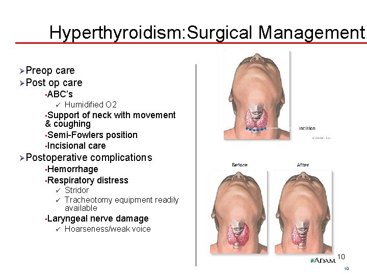 Hyperthyroidism: Surgical Management ØPreop care ØPost op care • ABC’s ü Humidified O 2