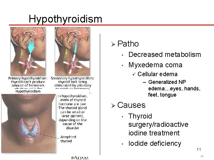 Hypothyroidism Ø Patho • • Decreased metabolism Myxedema coma ü Cellular edema – Generalized