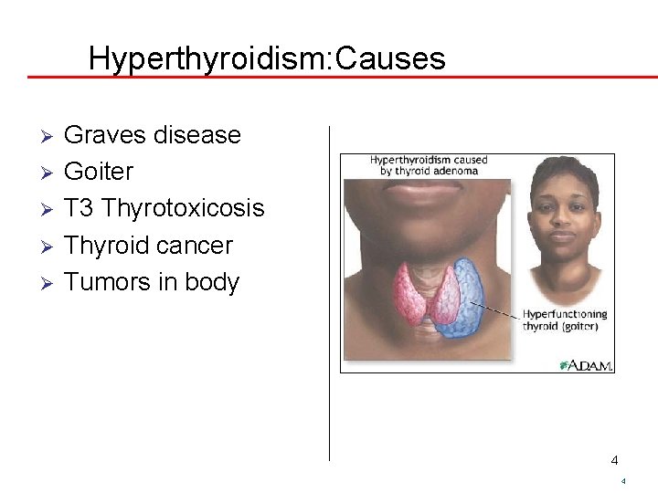 Hyperthyroidism: Causes Ø Ø Ø Graves disease Goiter T 3 Thyrotoxicosis Thyroid cancer Tumors