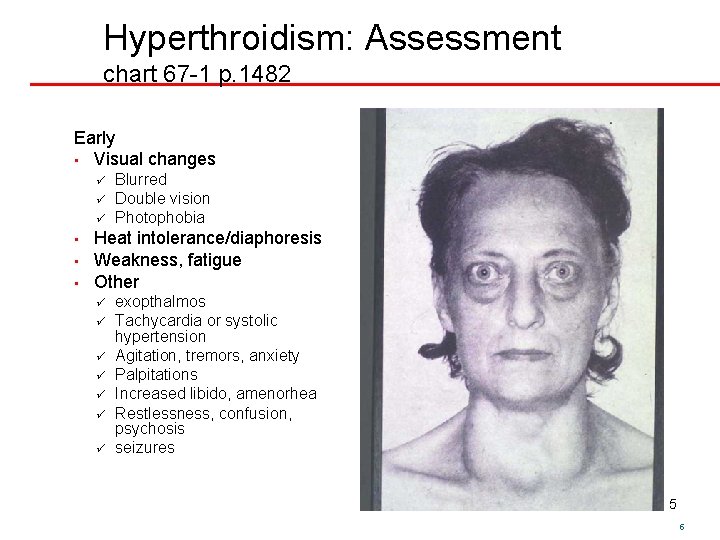 Hyperthroidism: Assessment chart 67 -1 p. 1482 Early • Visual changes ü ü ü