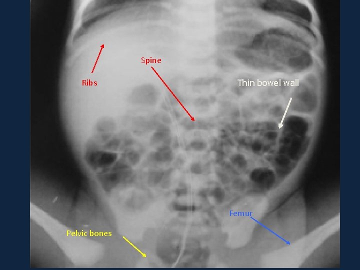 Spine Ribs Thin bowel wall Femur Pelvic bones Spine Ribs Thin bowel wall Femur Pelvic bones