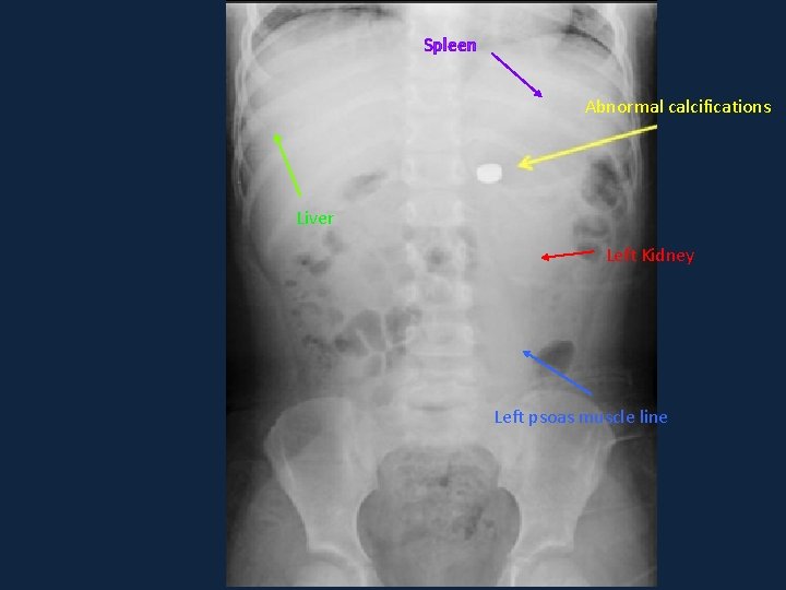 Spleen Abnormal calcifications Liver Left Kidney Left psoas muscle line Spleen Abnormal calcifications Liver Left Kidney Left psoas muscle line