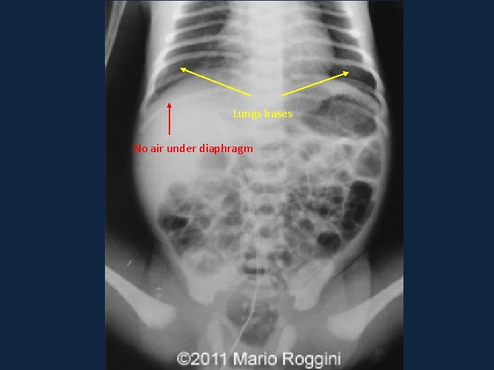 Lungs bases No air under diaphragm Lungs bases No air under diaphragm