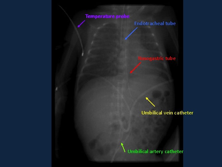 Temperature probe Endotracheal tube Nasogastric tube Umbilical vein catheter Umbilical artery catheter Temperature probe Endotracheal tube Nasogastric tube Umbilical vein catheter Umbilical artery catheter