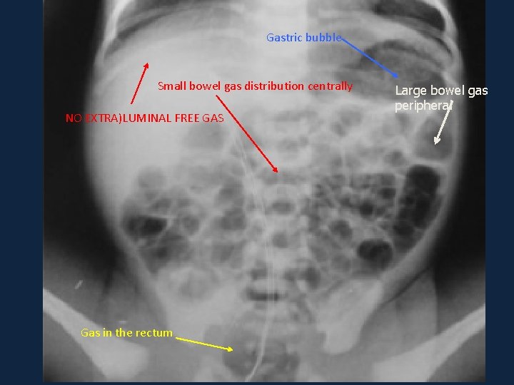 Gastric bubble Small bowel gas distribution centrally NO EXTRA)LUMINAL FREE GAS Gas in the Gastric bubble Small bowel gas distribution centrally NO EXTRA)LUMINAL FREE GAS Gas in the