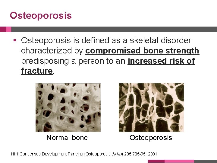 Osteoporosis § Osteoporosis is defined as a skeletal disorder characterized by compromised bone strength