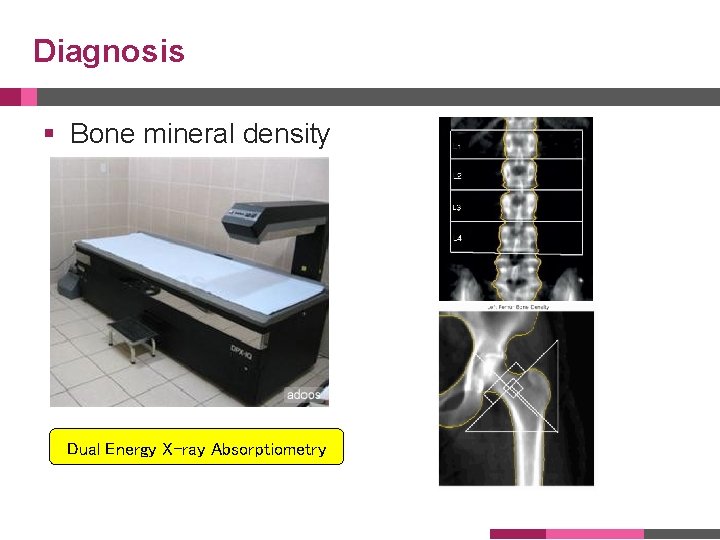 Diagnosis § Bone mineral density Dual Energy X-ray Absorptiometry 