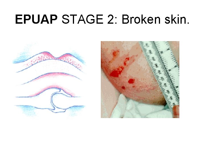 EPUAP STAGE 2: Broken skin. 