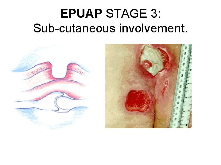 EPUAP STAGE 3: Sub-cutaneous involvement. 