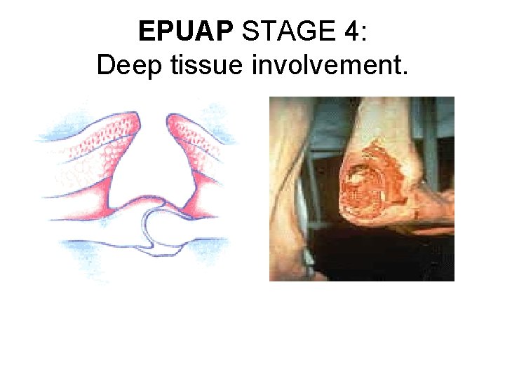 EPUAP STAGE 4: Deep tissue involvement. 