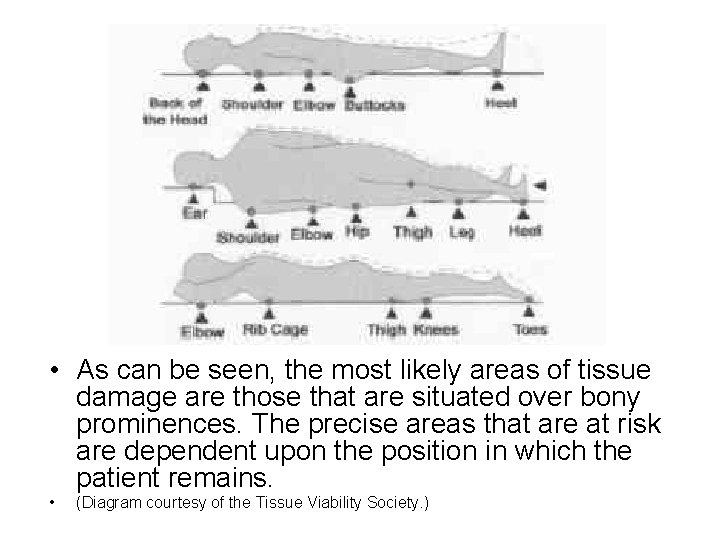  • As can be seen, the most likely areas of tissue damage are