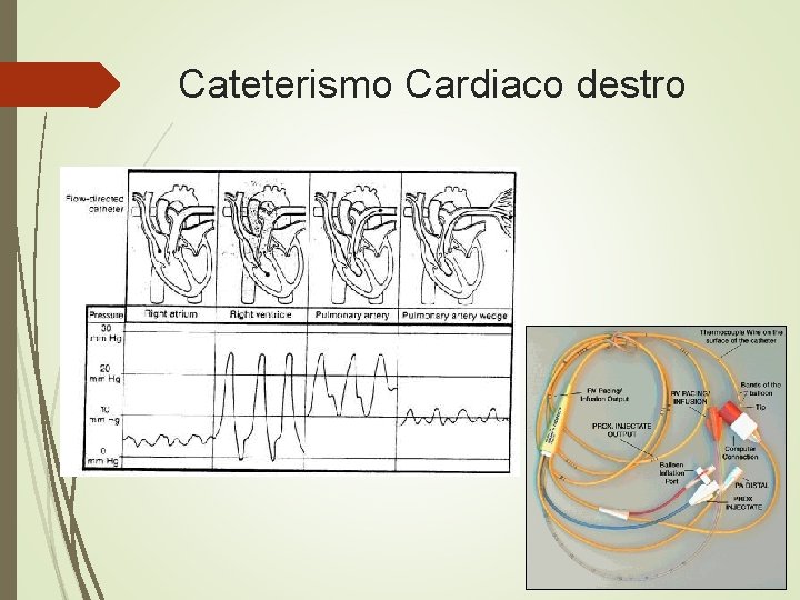 Cateterismo Cardiaco destro Cateterismo Cardiaco destro