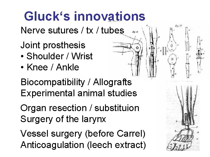 Gluck‘s innovations Nerve sutures / tx / tubes Joint prosthesis • Shoulder / Wrist
