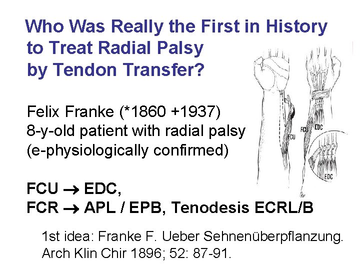 Who Was Really the First in History to Treat Radial Palsy by Tendon Transfer?