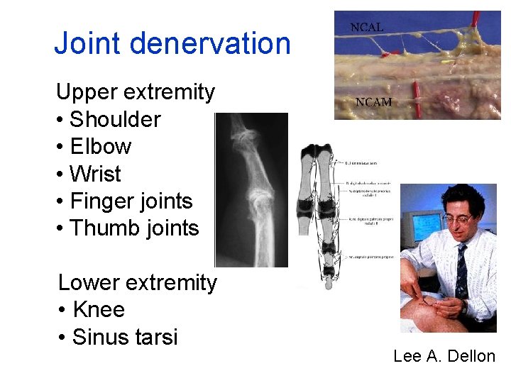 Joint denervation Upper extremity • Shoulder • Elbow • Wrist • Finger joints •