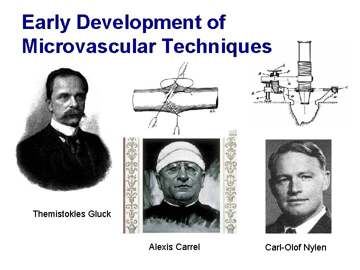 Early Development of Microvascular Techniques Themistokles Gluck Alexis Carrel Carl-Olof Nylen 