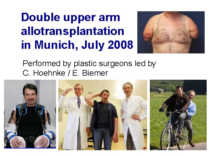 Double upper arm allotransplantation in Munich, July 2008 Performed by plastic surgeons led by