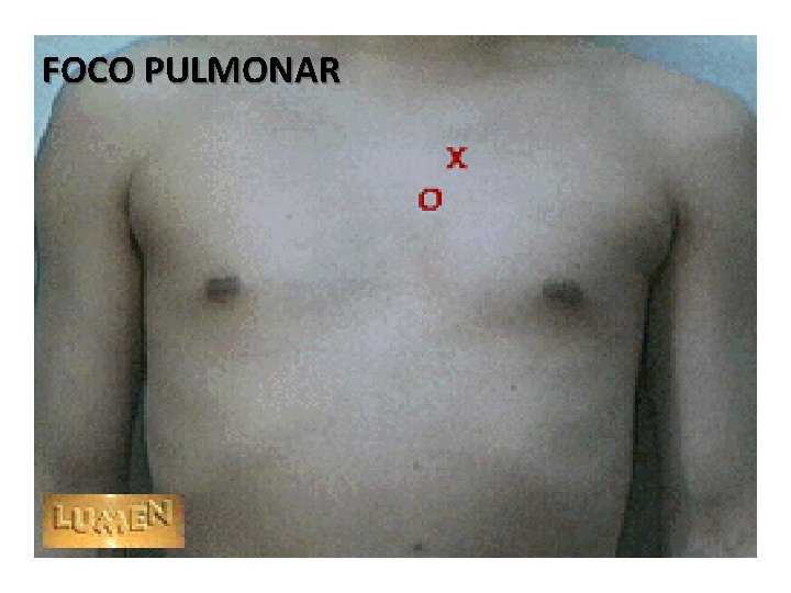 FOCO PULMONAR 