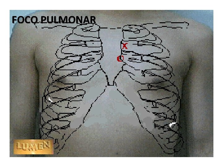 FOCO PULMONAR 