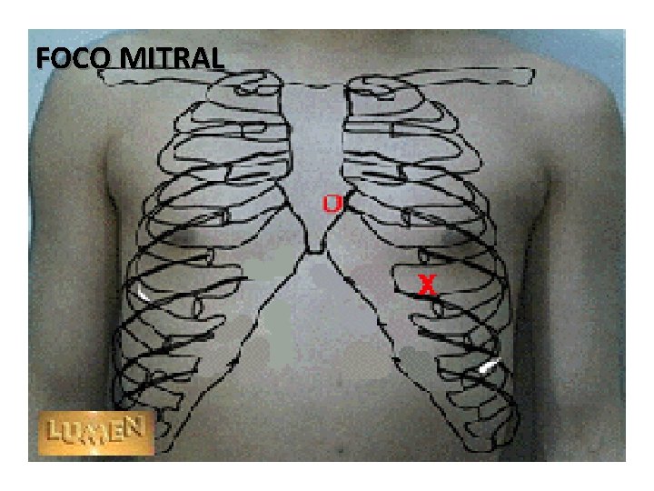 FOCO MITRAL 